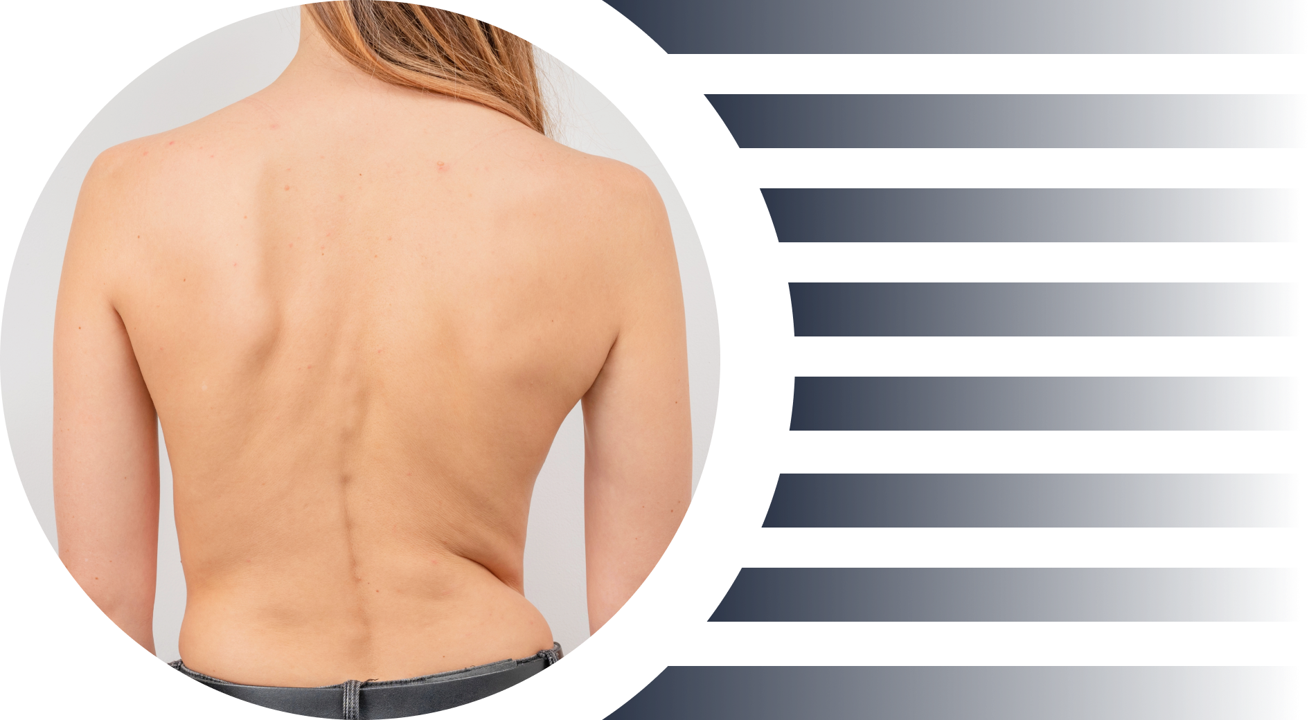 Imagem Cirurgia de Escoliose