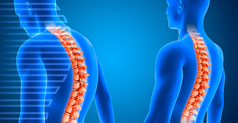 Imagem Cirurgia de Hérnia de Disco