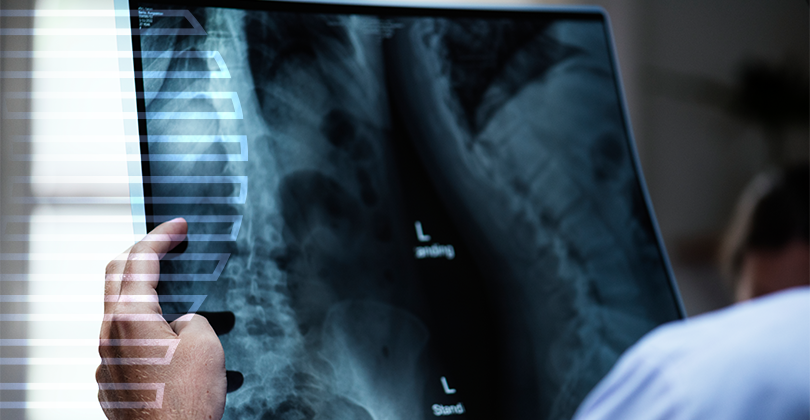 Imagem Cirurgia de Hérnia de Disco