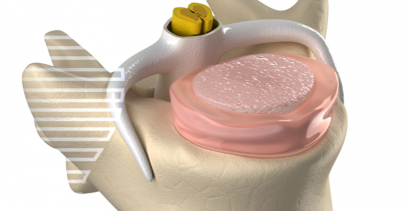 Imagem Cirurgia de Hérnia de Disco